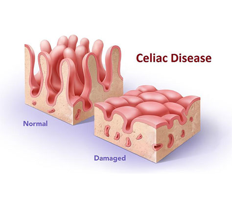 Celiac Disease Buffalo NY
