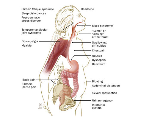 irritable bowel syndrome bloating